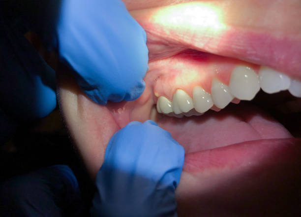 Best Emergency Broken Tooth Repair in Fort Dodge, IA